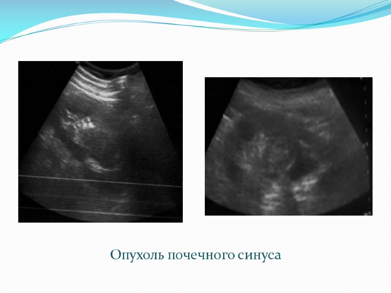 Опухоль почечного синуса